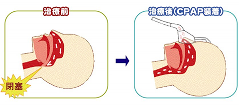 CPAPの効果