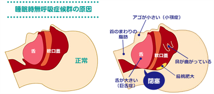 なぜ日本人は痩せていても無呼吸になるのかのイメージ画像